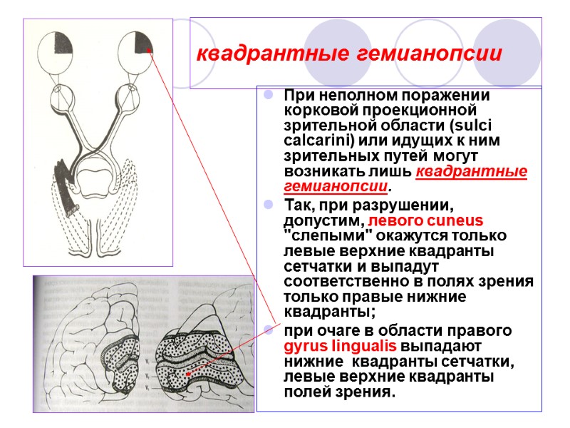 квадрантные гемианопсии При неполном поражении корковой проекционной зрительной области (sulci calcarini) или идущих к